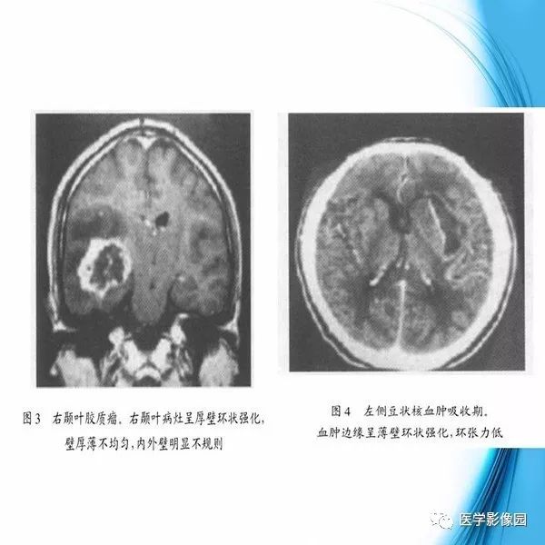 【PPT】颅内结核MRI影像表现及鉴别诊断