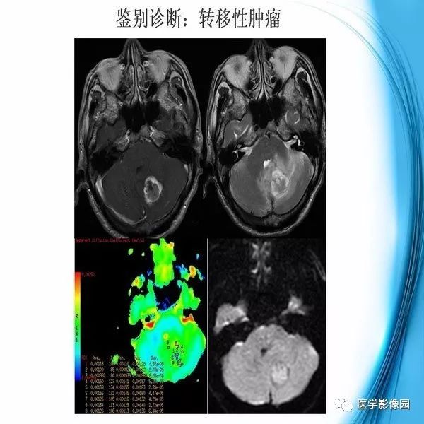 【PPT】颅内结核MRI影像表现及鉴别诊断