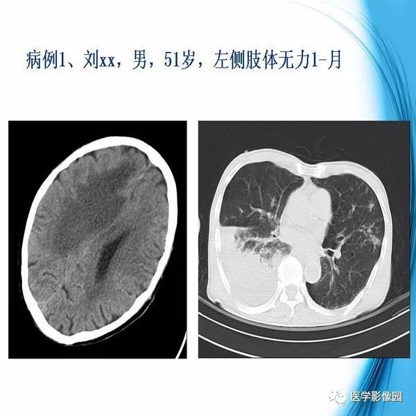 【PPT】颅内结核MRI影像表现及鉴别诊断
