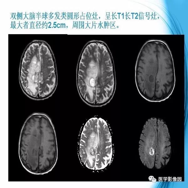 【PPT】颅内结核MRI影像表现及鉴别诊断