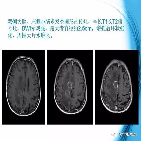【PPT】颅内结核MRI影像表现及鉴别诊断