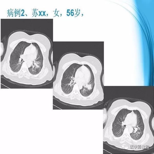 【PPT】颅内结核MRI影像表现及鉴别诊断