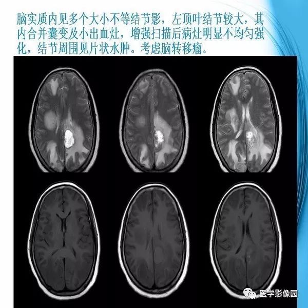 【PPT】颅内结核MRI影像表现及鉴别诊断