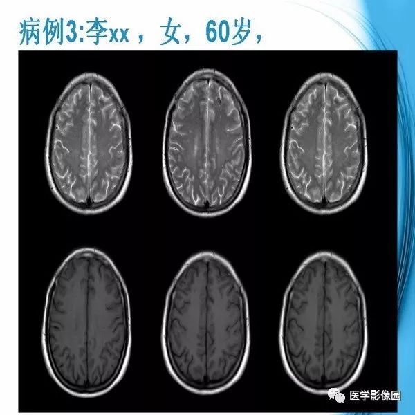 【PPT】颅内结核MRI影像表现及鉴别诊断