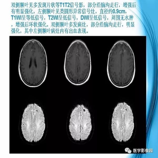 【PPT】颅内结核MRI影像表现及鉴别诊断
