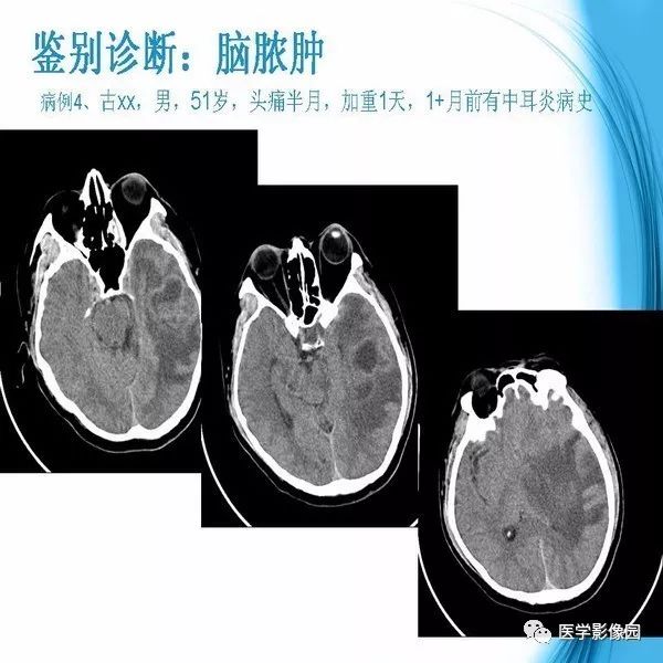 【PPT】颅内结核MRI影像表现及鉴别诊断