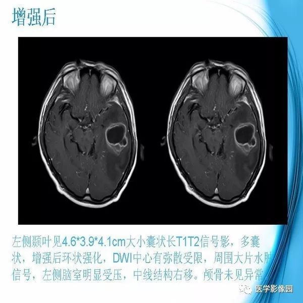 【PPT】颅内结核MRI影像表现及鉴别诊断