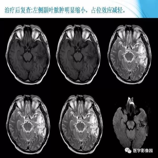 【PPT】颅内结核MRI影像表现及鉴别诊断
