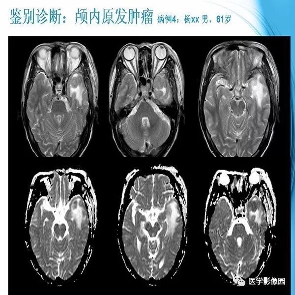 【PPT】颅内结核MRI影像表现及鉴别诊断