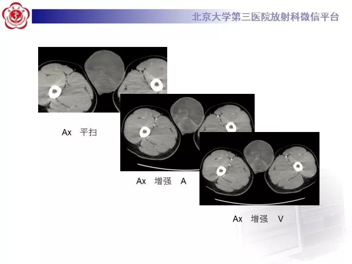 【病例】睾丸横纹肌肉瘤1例CT及MR影像思路分析