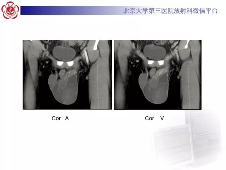 【病例】睾丸横纹肌肉瘤1例CT及MR影像思路分析