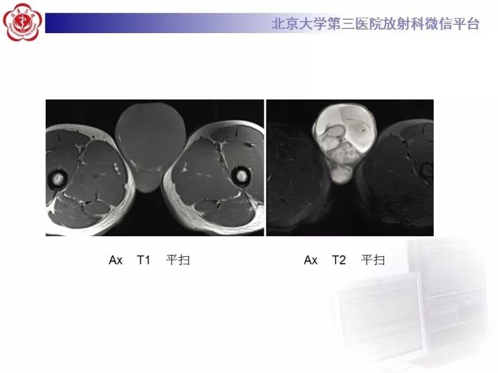 【病例】睾丸横纹肌肉瘤1例CT及MR影像思路分析