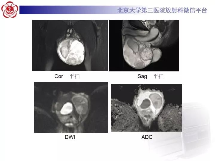 【病例】睾丸横纹肌肉瘤1例CT及MR影像思路分析