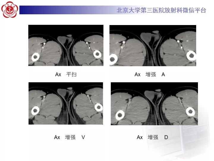【病例】睾丸横纹肌肉瘤1例CT及MR影像思路分析