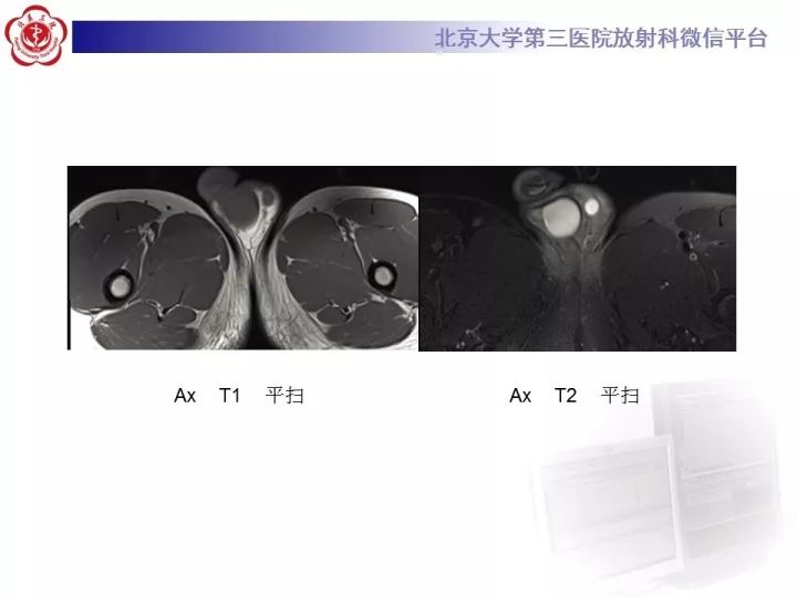 【病例】睾丸横纹肌肉瘤1例CT及MR影像思路分析