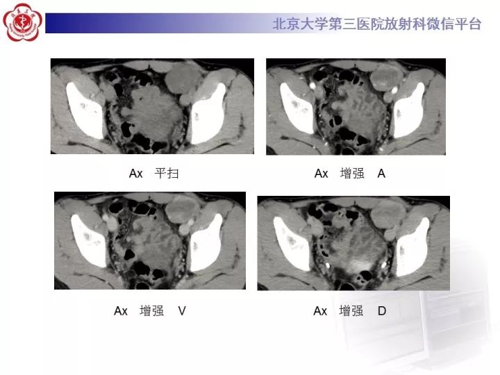 【病例】睾丸横纹肌肉瘤1例CT及MR影像思路分析