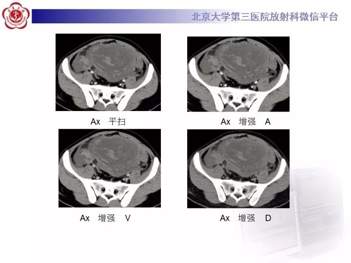 【病例】睾丸横纹肌肉瘤1例CT及MR影像思路分析