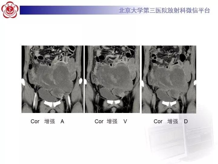 【病例】睾丸横纹肌肉瘤1例CT及MR影像思路分析