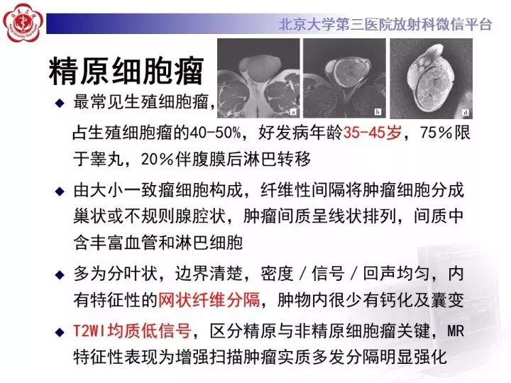 【病例】睾丸横纹肌肉瘤1例CT及MR影像思路分析