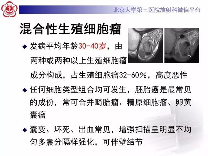 【病例】睾丸横纹肌肉瘤1例CT及MR影像思路分析