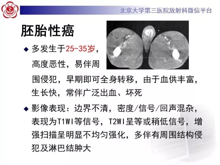 【病例】睾丸横纹肌肉瘤1例CT及MR影像思路分析