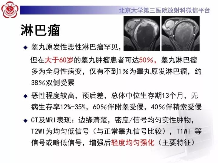 【病例】睾丸横纹肌肉瘤1例CT及MR影像思路分析