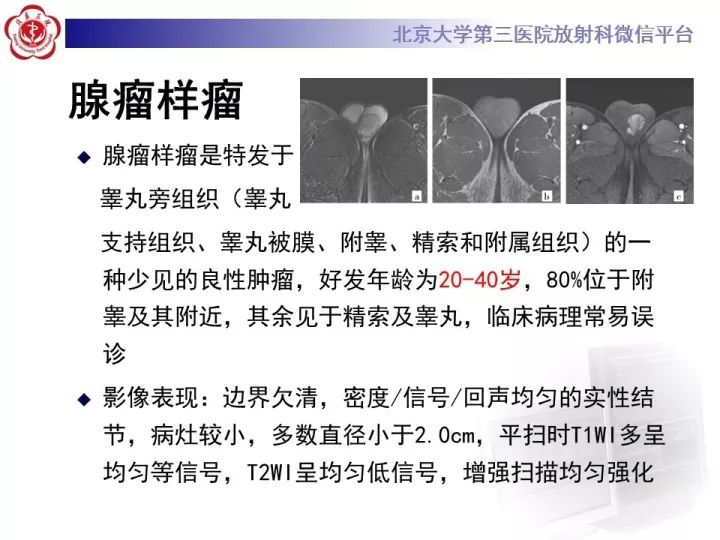 【病例】睾丸横纹肌肉瘤1例CT及MR影像思路分析