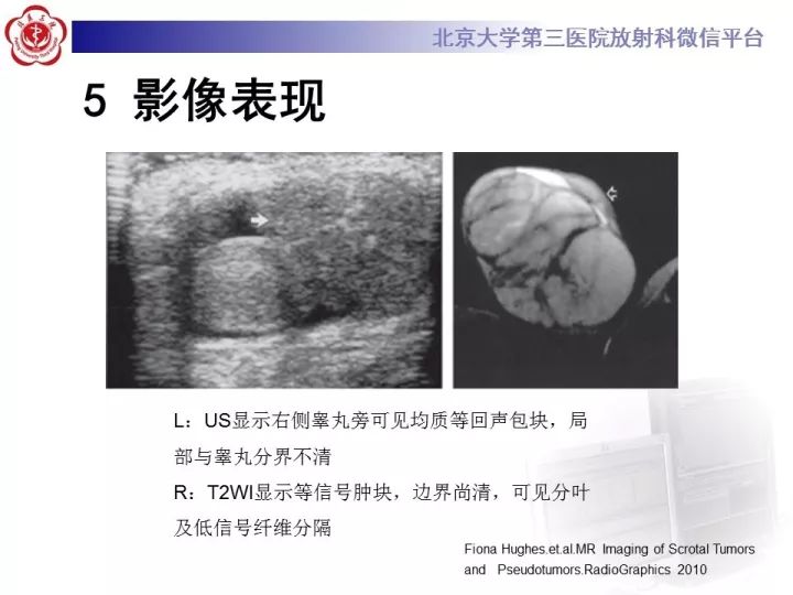 【病例】睾丸横纹肌肉瘤1例CT及MR影像思路分析