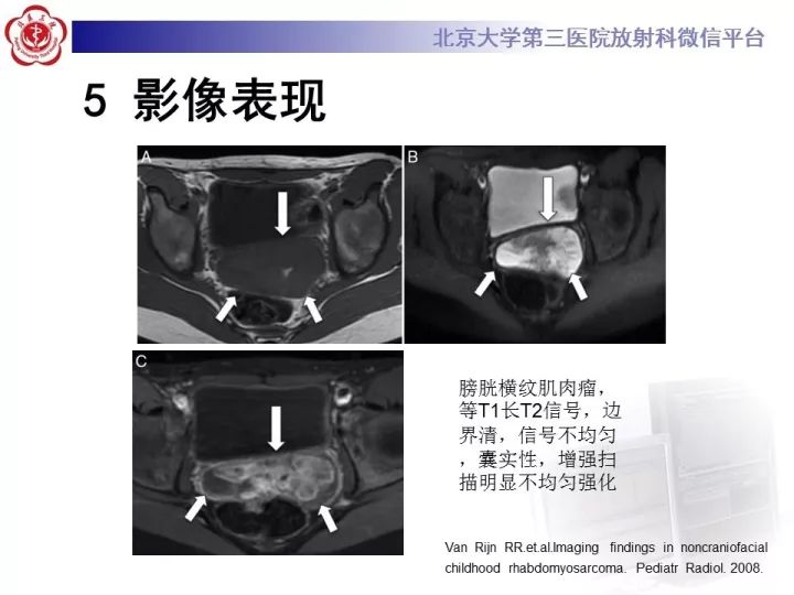【病例】睾丸横纹肌肉瘤1例CT及MR影像思路分析
