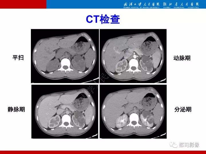 【PPT】多房囊性肾瘤影像诊断