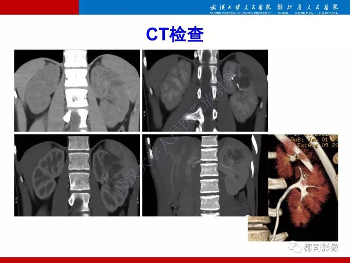 【PPT】多房囊性肾瘤影像诊断