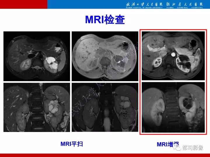 【PPT】多房囊性肾瘤影像诊断
