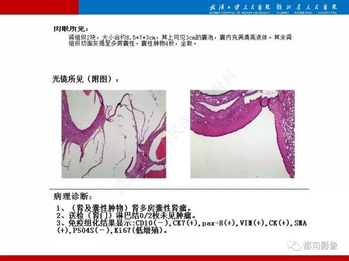 【PPT】多房囊性肾瘤影像诊断