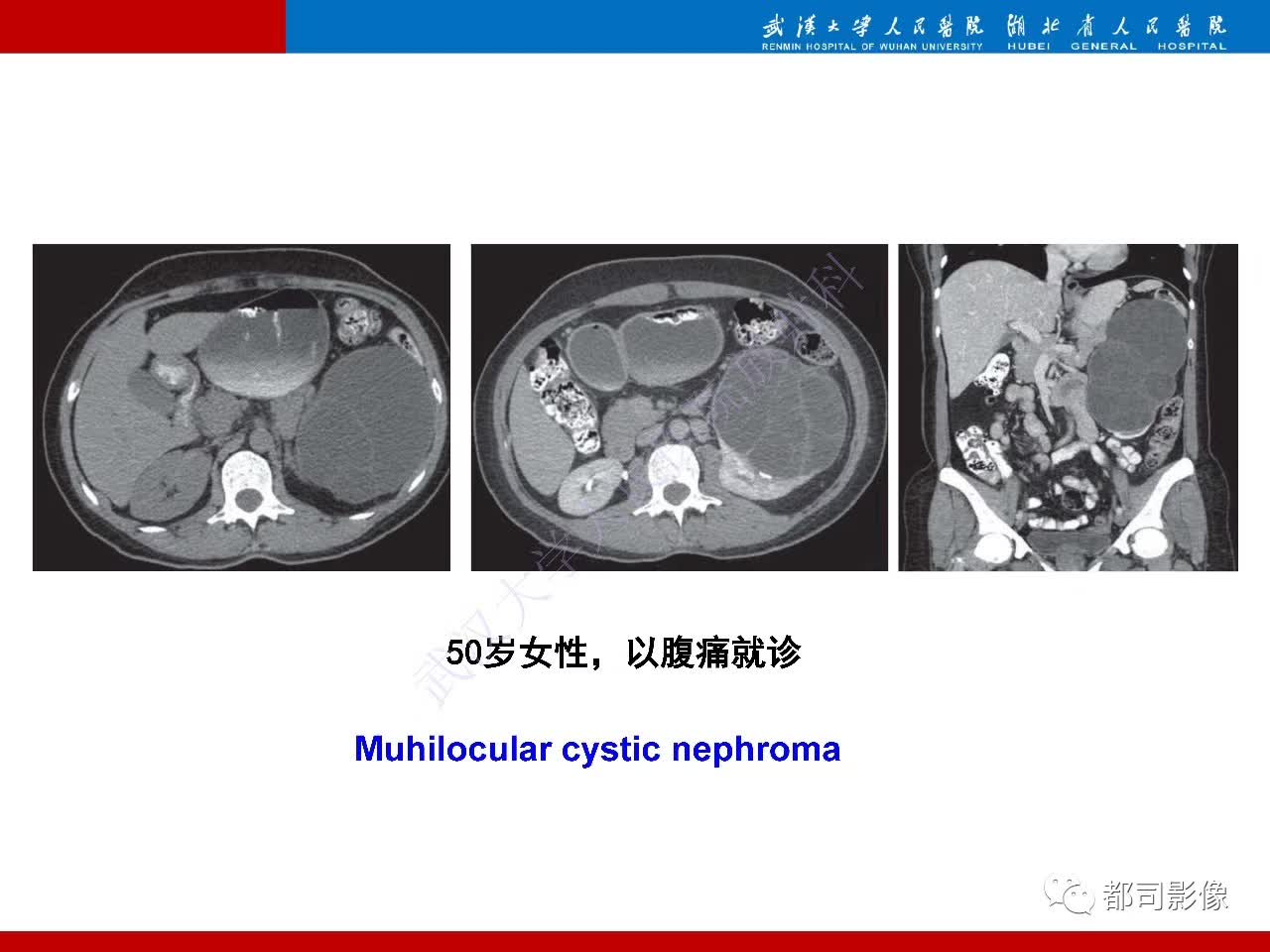 【PPT】多房囊性肾瘤影像诊断