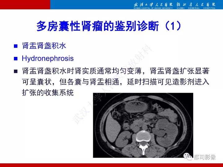 【PPT】多房囊性肾瘤影像诊断
