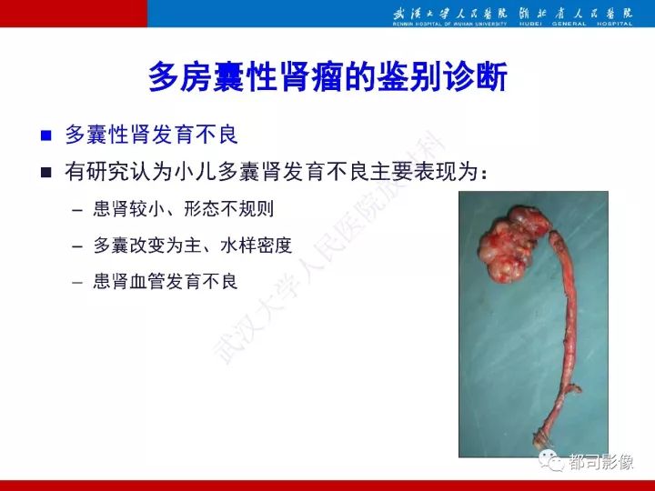 【PPT】多房囊性肾瘤影像诊断