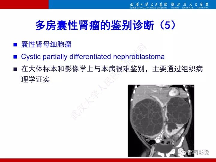 【PPT】多房囊性肾瘤影像诊断