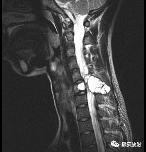 【病例】腰椎骨巨细胞瘤1例X线CT及MR影像表现