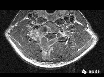 【病例】腰椎骨巨细胞瘤1例X线CT及MR影像表现