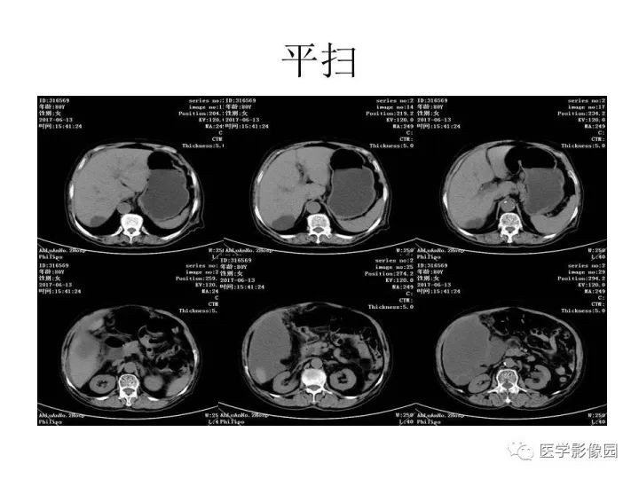 【病例】腹腔多发假性粘液瘤1例CT影像表现