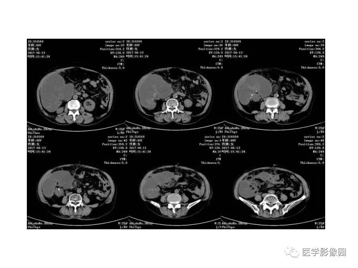 【病例】腹腔多发假性粘液瘤1例CT影像表现