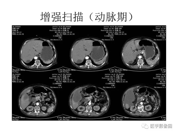 【病例】腹腔多发假性粘液瘤1例CT影像表现