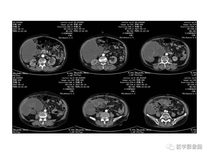 【病例】腹腔多发假性粘液瘤1例CT影像表现