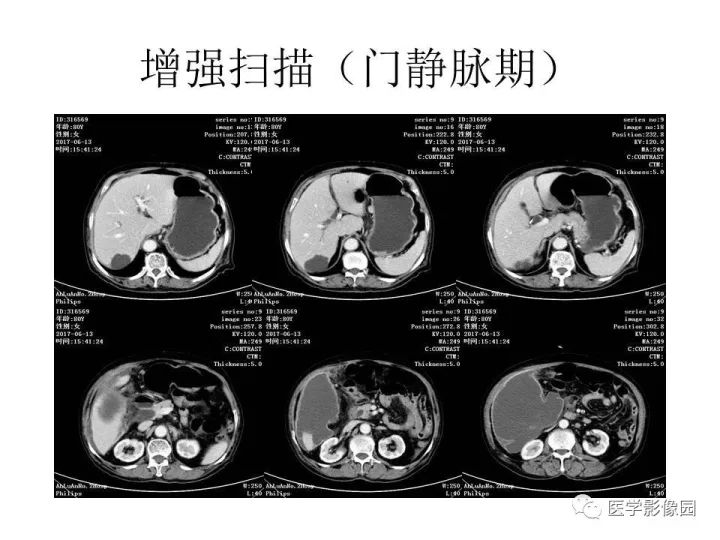【病例】腹腔多发假性粘液瘤1例CT影像表现