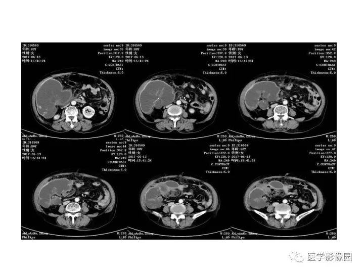 【病例】腹腔多发假性粘液瘤1例CT影像表现