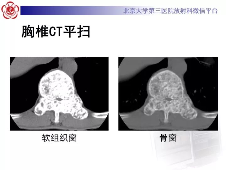 【病例】胸椎软骨肉瘤1例CT及MR影像表现