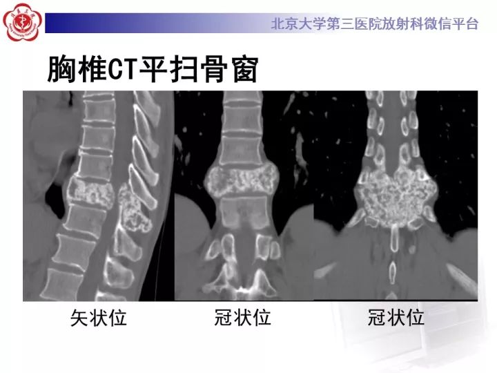 【病例】胸椎软骨肉瘤1例CT及MR影像表现