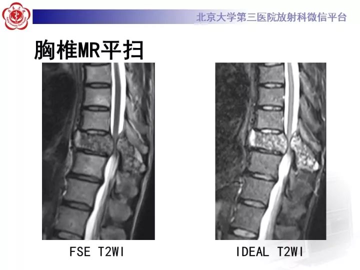 【病例】胸椎软骨肉瘤1例CT及MR影像表现