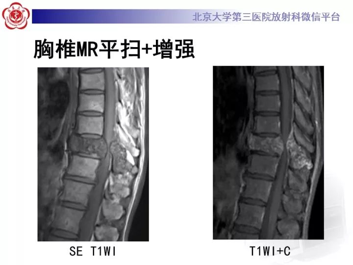 【病例】胸椎软骨肉瘤1例CT及MR影像表现