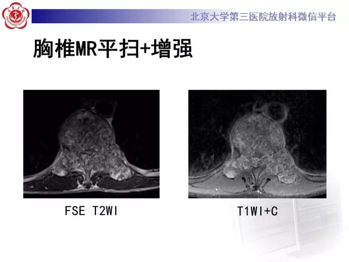 【病例】胸椎软骨肉瘤1例CT及MR影像表现